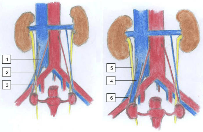 Patient has ovarian vein syndrome and has ureterolysis performed