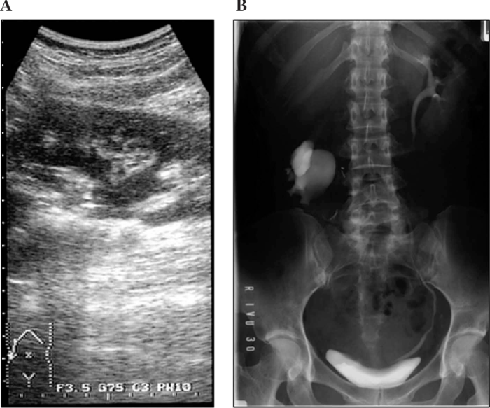 Patient has ovarian vein syndrome and has ureterolysis performed