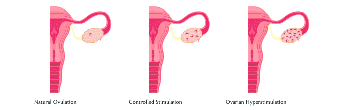 Patient has ovarian vein syndrome and has ureterolysis performed