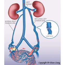 Patient has ovarian vein syndrome and has ureterolysis performed