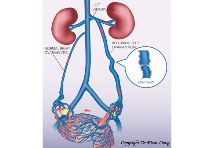 Patient has ovarian vein syndrome and has ureterolysis performed